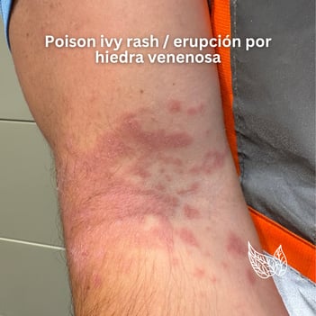 hatcher-landscape-poison-ivy-rash-1