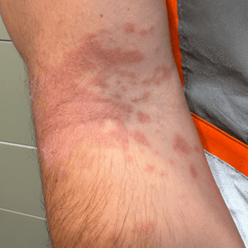 poison-ivy-rash-1